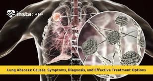 llustration of Noshadar thinning thick mucus in bronchial tubes to help coughing